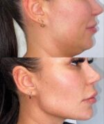V-Face Lifting Device - Image 3