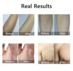 Analogue hair removal laser - Image 4